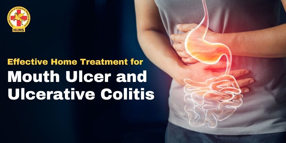 Effective Home Treatment for Mouth Ulcer and Ulcerative Colitis