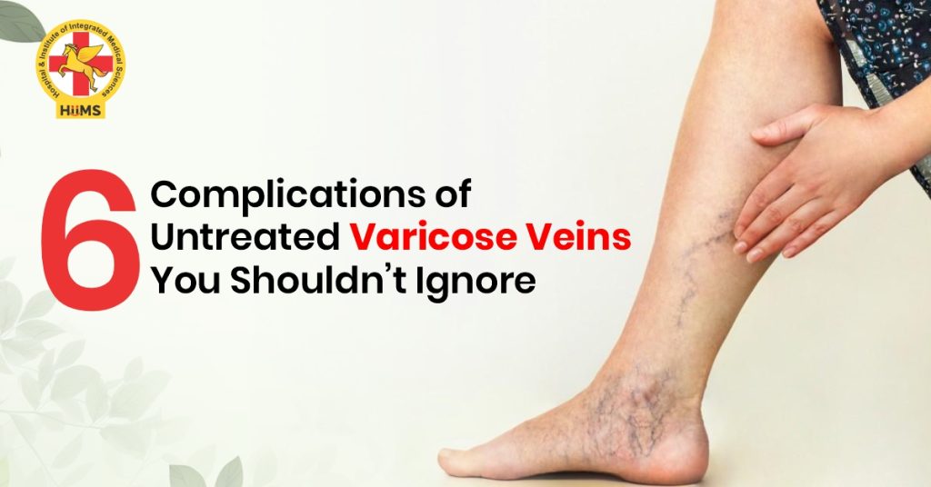 complications of varicose veins