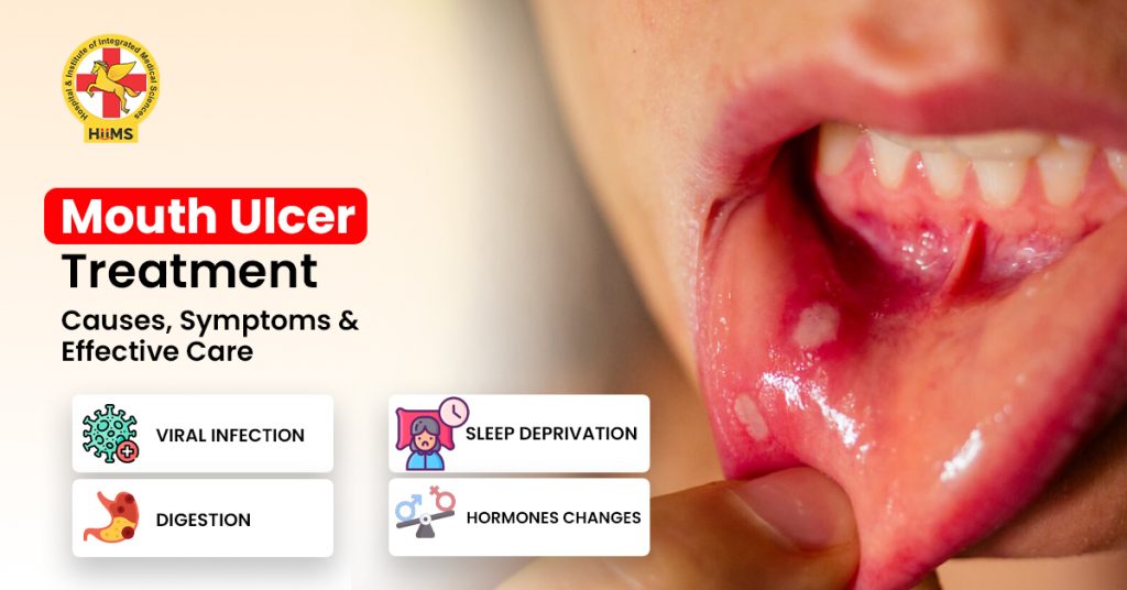 Mouth Ulcer Treatment – Causes, Symptoms & Effective Care