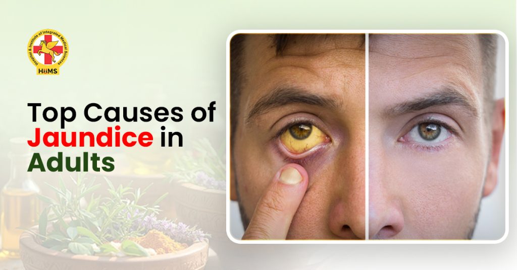 Top Causes of Jaundice in Adults