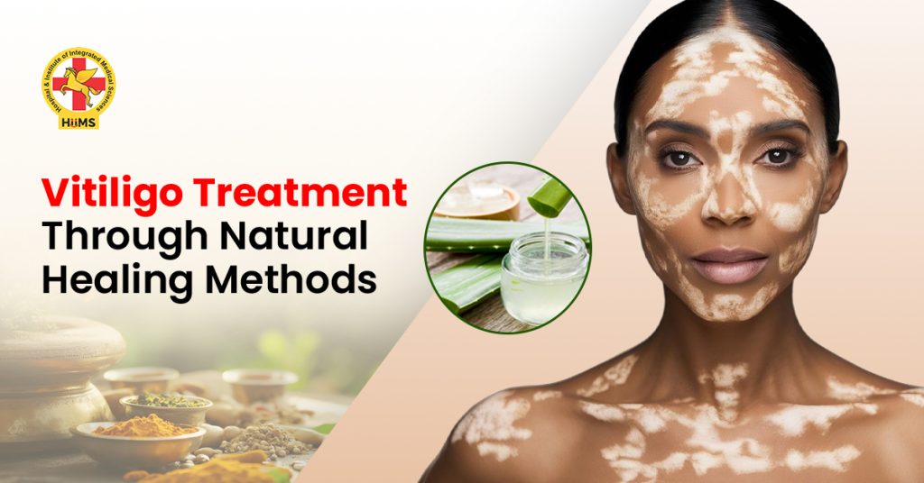 Vitiligo treatment for white patches on skin
