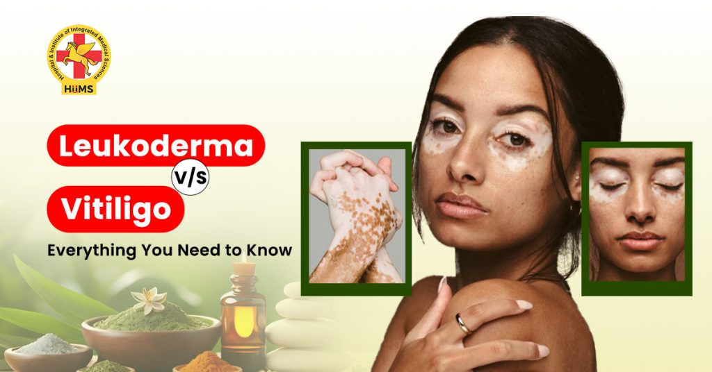 • Leukoderma Treatment for White Patches on Skin