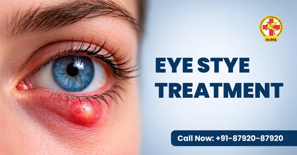 eye stye treatment