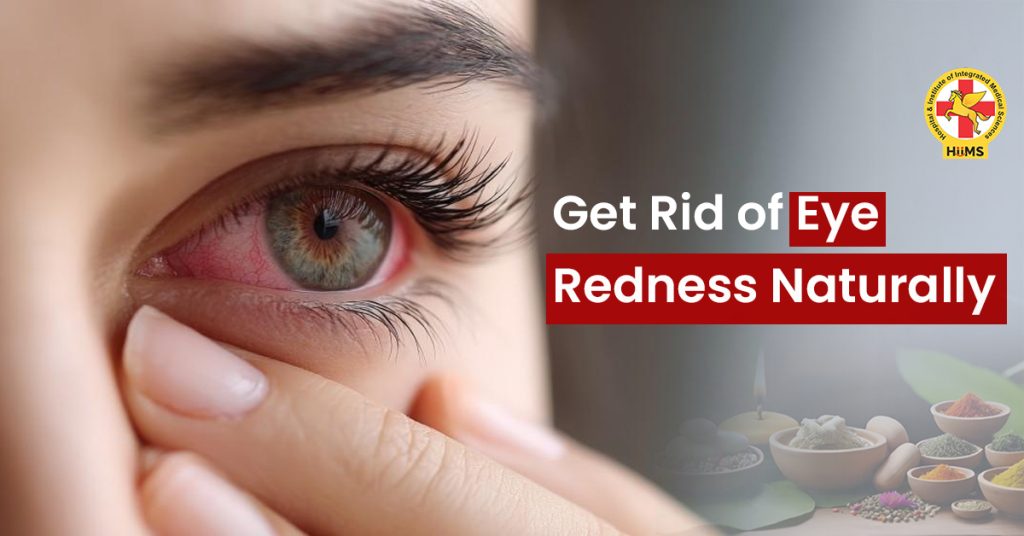 reduce eye redness naturally