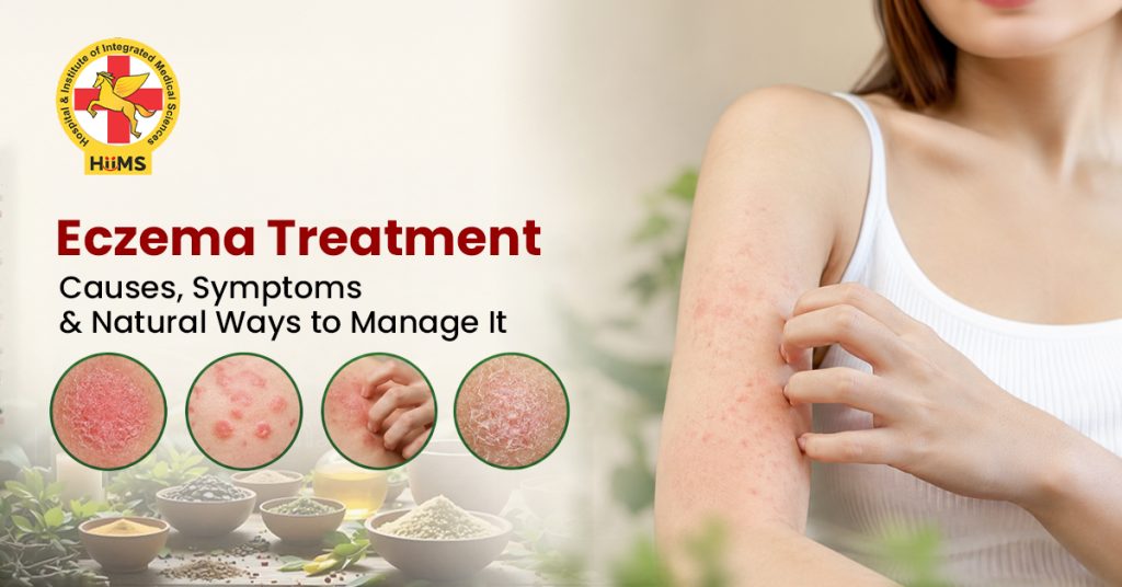 Eczema Treatment: