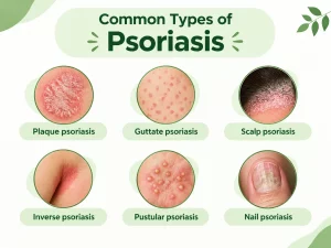 Common types of psoriasis