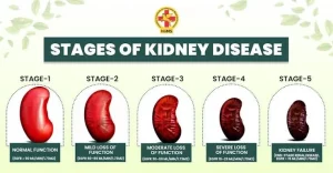 5 stages of chronic kidney disease showing symptoms and kidney function progression