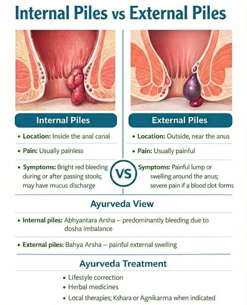 internal vs external piles type