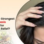 Scalp Psoriasis Treatment