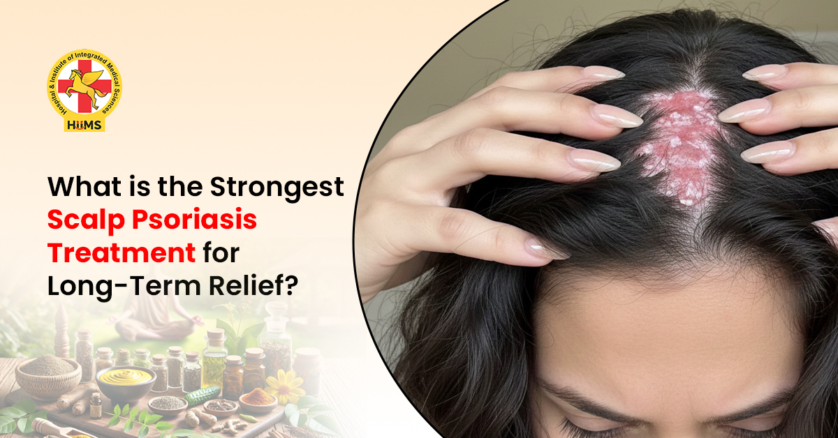 Strongest Scalp Psoriasis Treatment For Long Term Relief