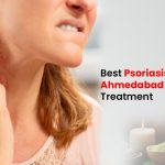 Best Psoriasis Doctor in Ahmedabad for Effective Treatment