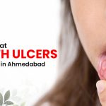 How to Treat Mouth Ulcers: Expert Care in Ahmedabad