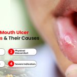 Common Mouth Ulcer Symptoms and Their Causes