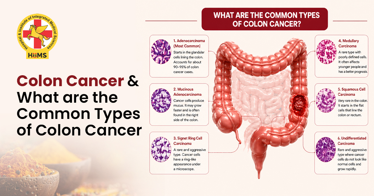 Colon Cancer and What Are the Common Types of Colon Cancer