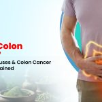 What is Colon Cancer? Symptoms, Causes & Colon Cancer Treatment Explained