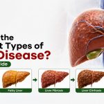 What Are the Different Types of Liver Disease? A Complete Guide