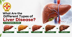 What-Are-the-Different-Types-of-Liver-Disease