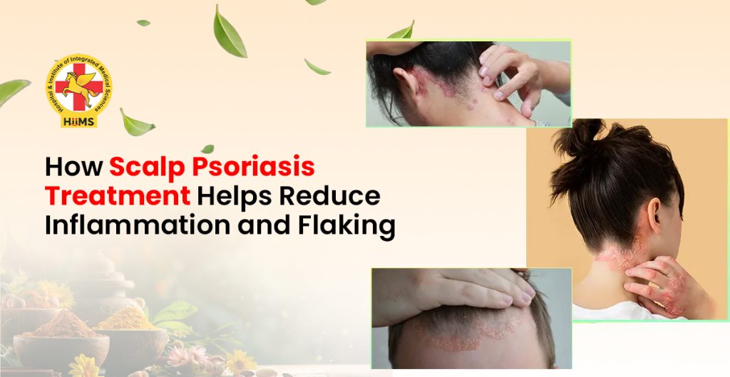 Scalp Psoriasis Treatment