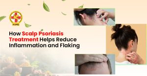 Scalp Psoriasis Treatment