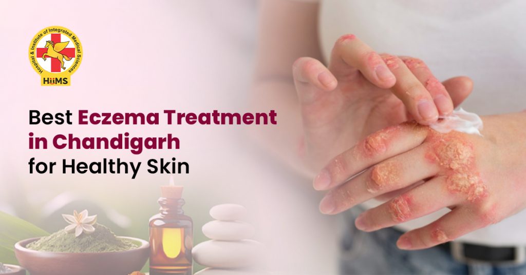 Best Eczema Treatment in Chandigarh