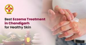 Best Eczema Treatment in Chandigarh