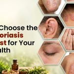 How to Choose the Right Psoriasis Specialist for Your Skin Health