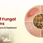Types of Fungal Infections: Causes, Symptoms & Treatment