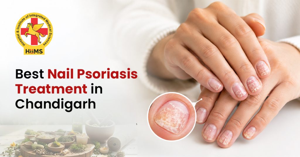 Best Nail Psoriasis Treatment in Chandigarh
