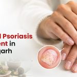 Nail Psoriasis Treatment in Chandigarh