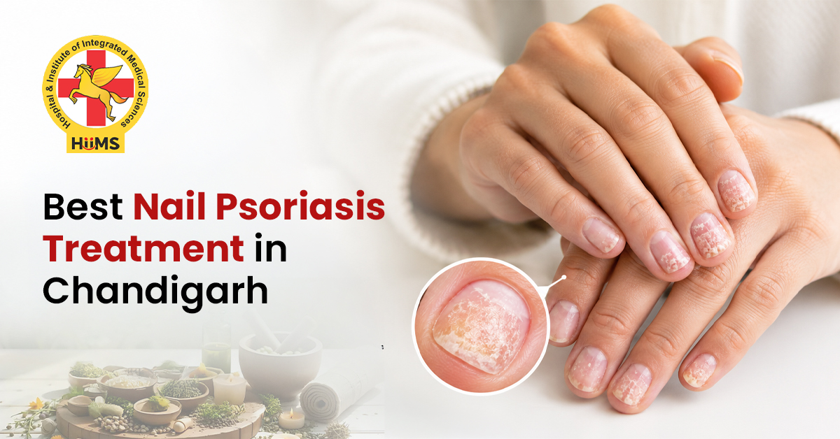 Best Nail Psoriasis Treatment in Chandigarh