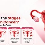 What Are the Stages of Ovarian Cancer? Signs, Diagnosis & Care