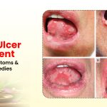 Mouth Ulcer Treatment: Causes, Symptoms & Effective Remedies