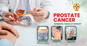 Prostate Cancer Symptoms, Causes & Treatment