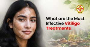 What Are the Most Effective Vitiligo Treatments