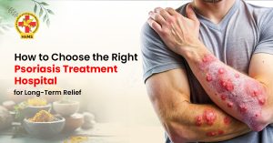 How to Choose the Right Psoriasis Treatment Hospital for Long-Term Relief