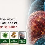 What Are the Most Common Causes of Acute Liver Failure?