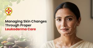 Leukoderma treatment and care for healthy skin