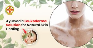 Leukoderma solution showing natural skin tone improvement