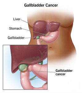 gallbladder-cancer
