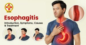 Esophagitis