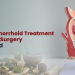 Best Hemorrhoid Treatment Without Surgery Explained
