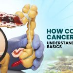 How Colon Cancer Starts: Understanding the Basics