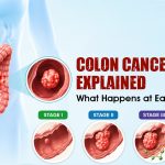 Colon Cancer Stages Explained: What Happens at Each Stage?