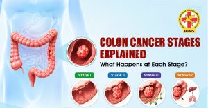 Colon Cancer Stages Explained What Happens at Each Stage