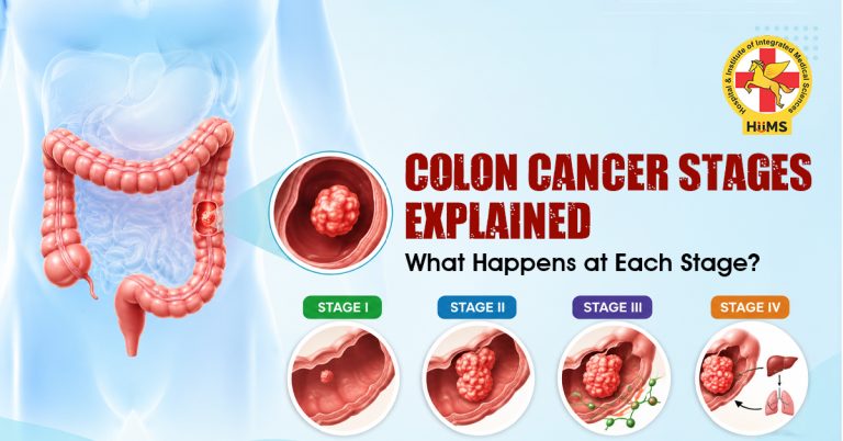 Colon Cancer Stages Explained What Happens at Each Stage