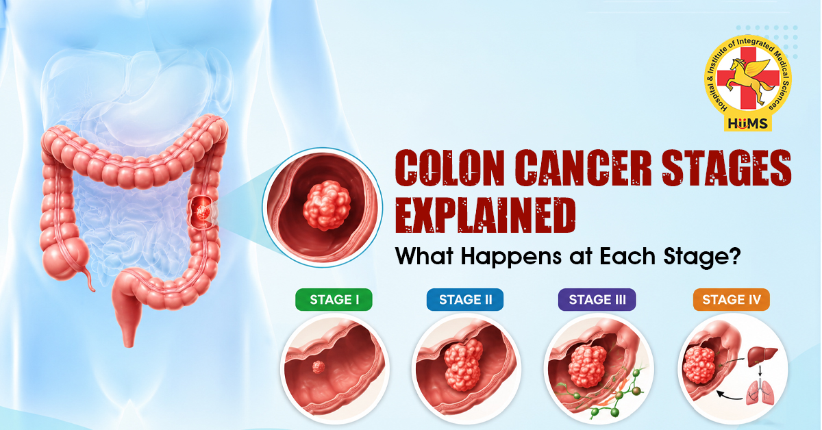 Colon Cancer Stages Explained What Happens at Each Stage
