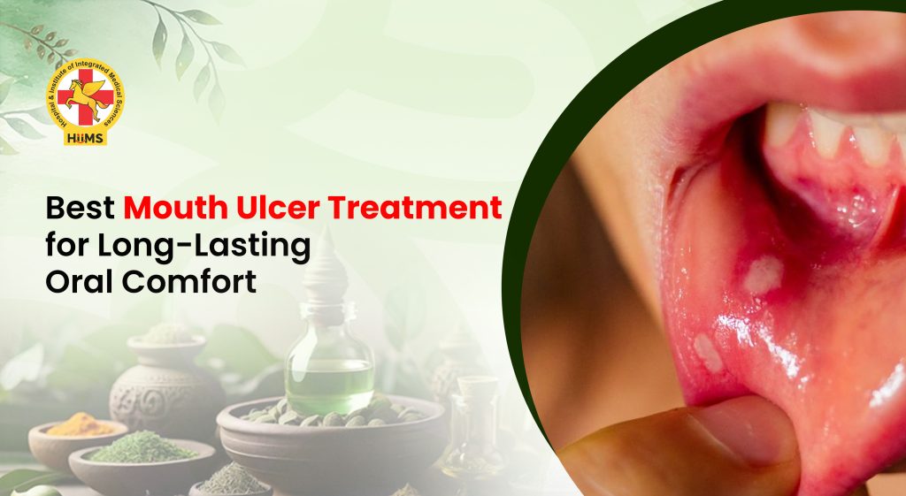 Mouth Ulcer Treatment for Long-Lasting