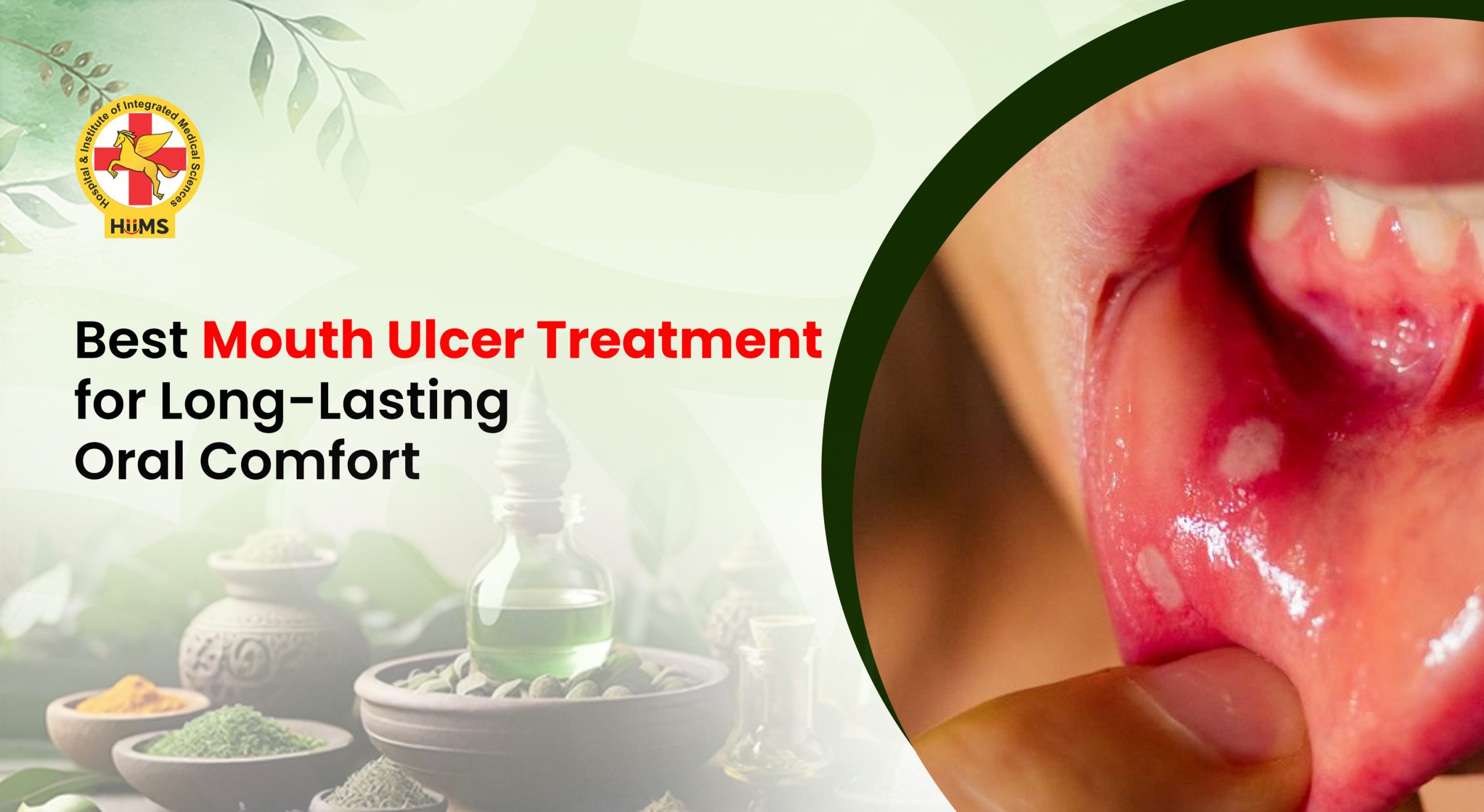 Mouth Ulcer Treatment for Long-Lasting