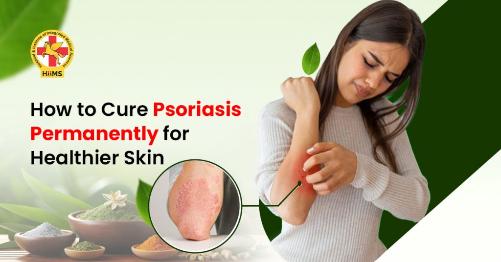 How to Cure Psoriasis Permanently for Healthier Skin