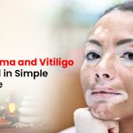 Leukoderma and Vitiligo Explained in Simple Language